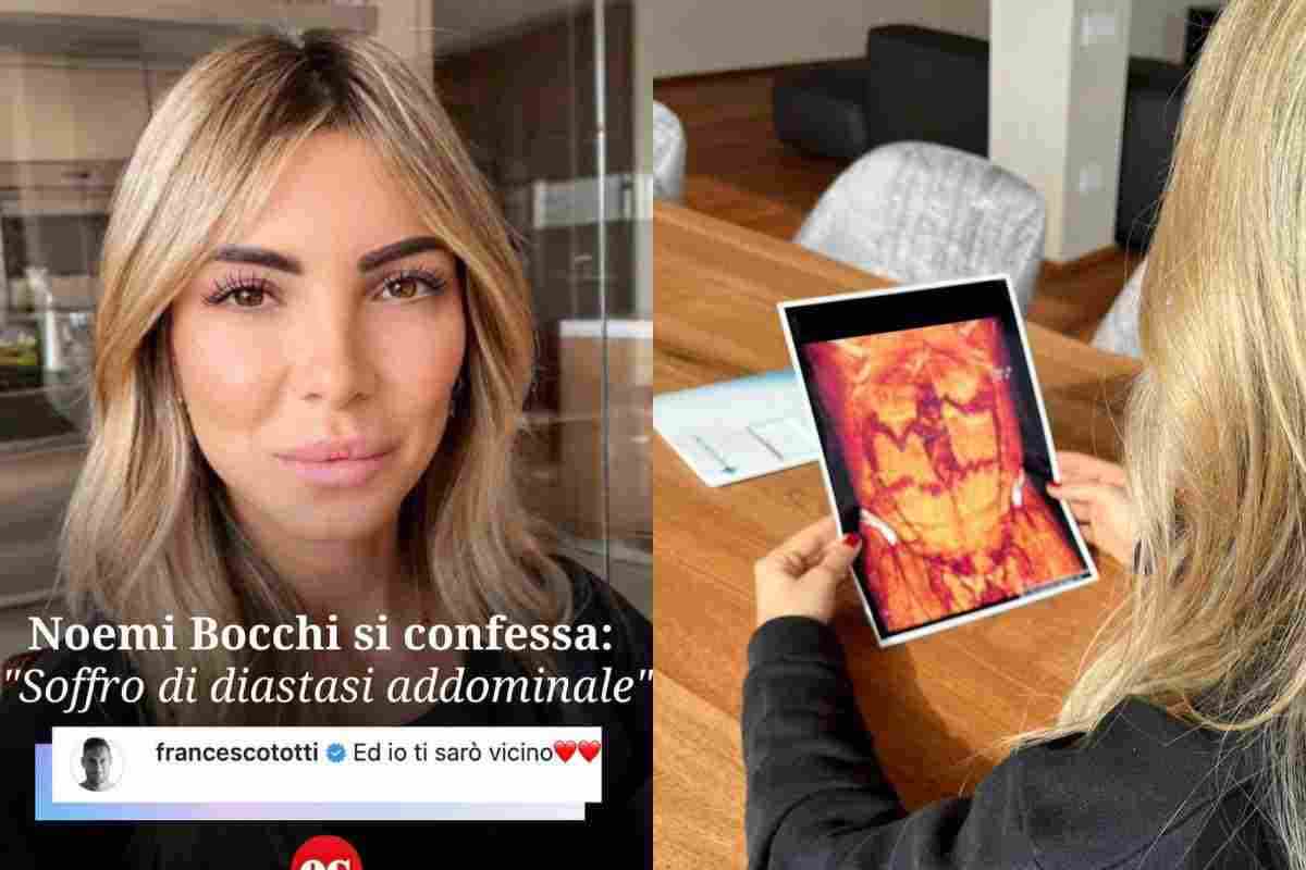 Noemi Bocchi diastasi addominale