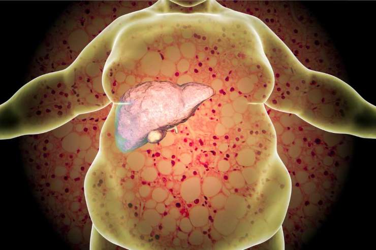 cos'è la sindrome del fegato grasso