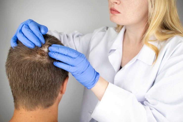 Alopecia androgenetica: cos'è e come colpisce