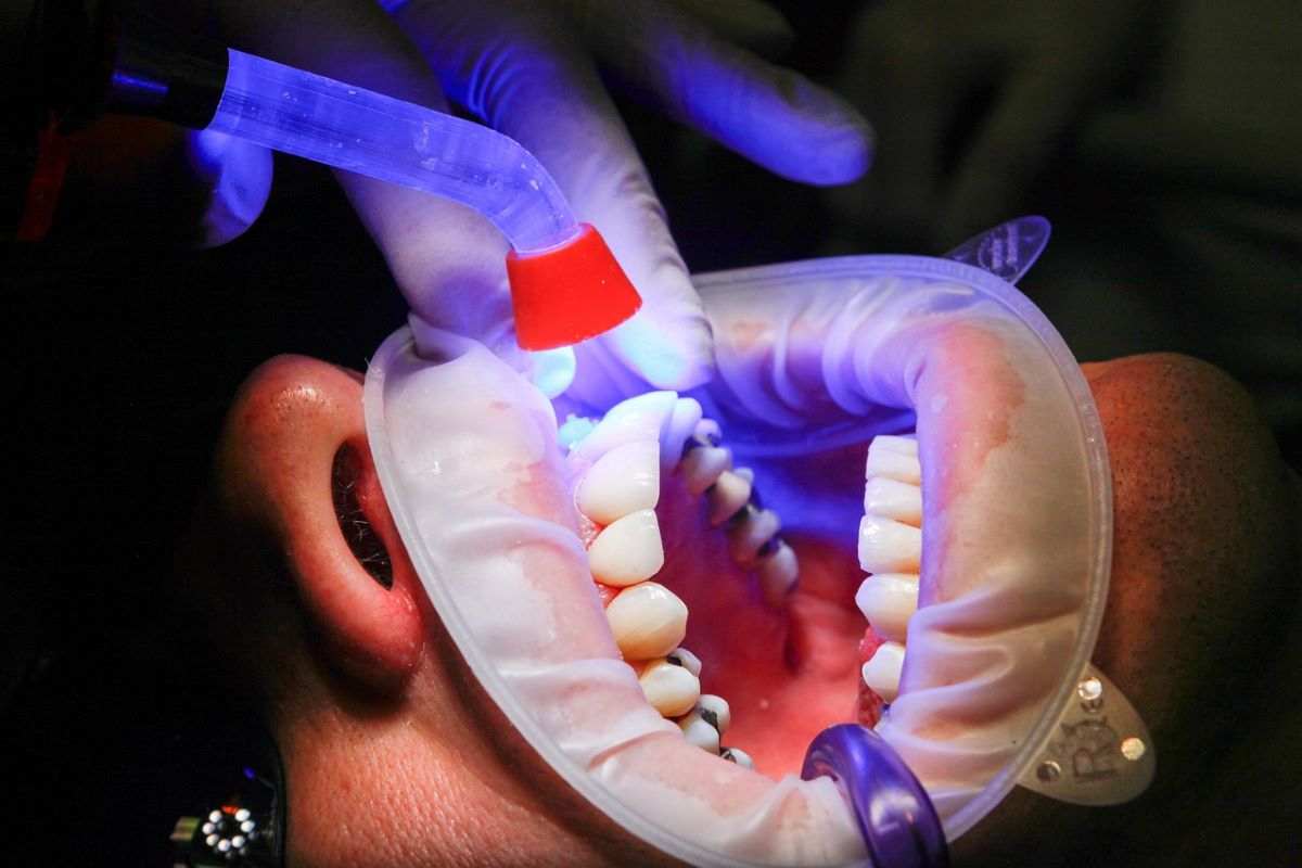 Síntomas de la diabetes que aparecen en nuestra boca y dientes: Presta atención