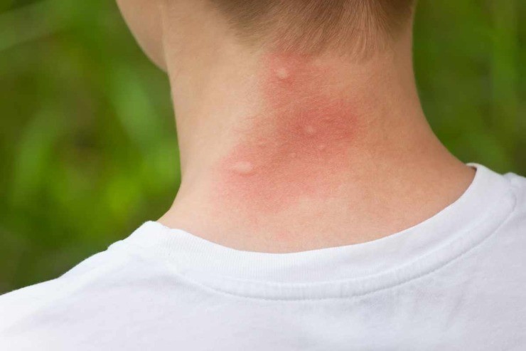 Puntura di zanzara: cosa fare