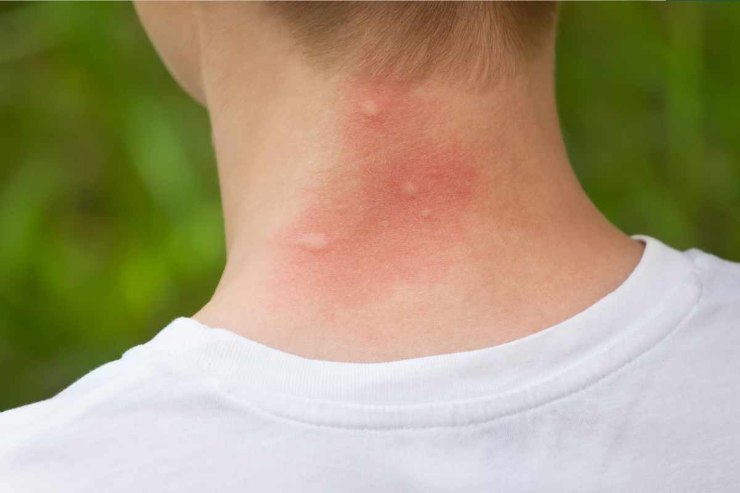 Puntura di zanzara: cause e conseguenze