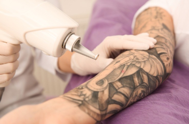 Cosa fare per cancellare un tatuaggio