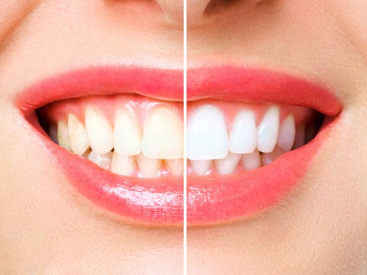 denti bianchi rimedi naturali