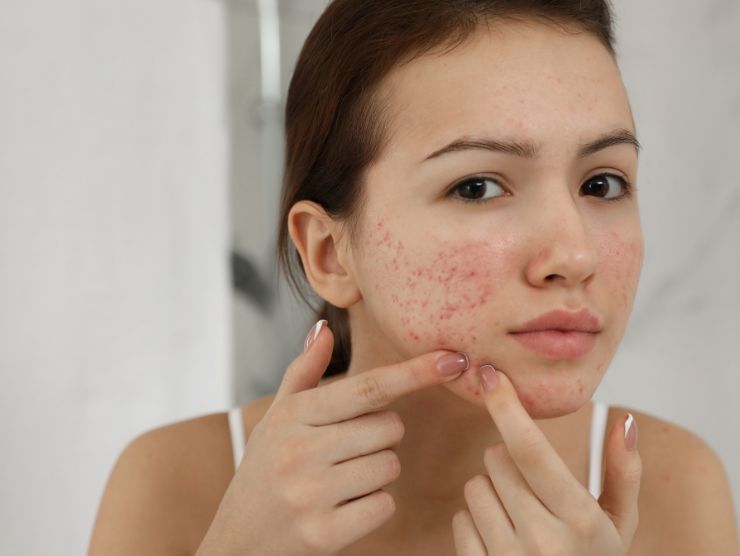 come proteggere pelle acne