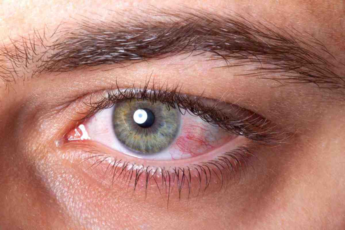 rischi raggi uv malattie occhi