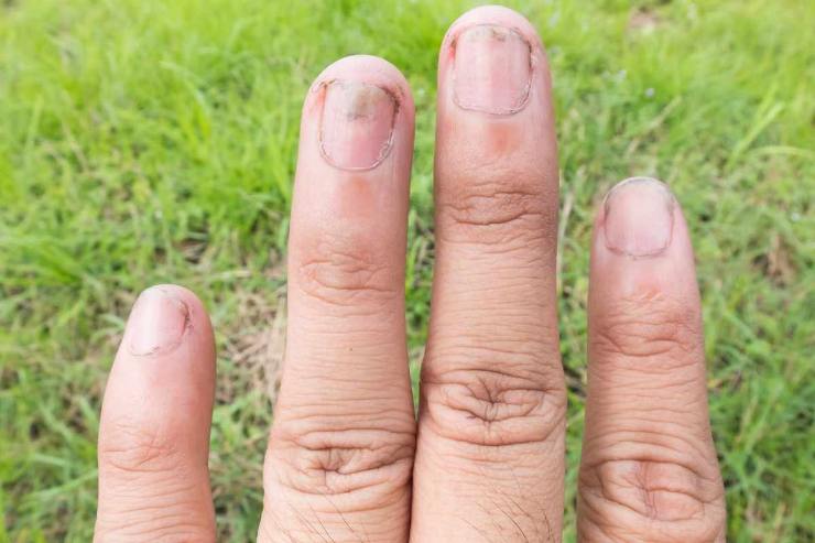 unghie sintomi malattia grave 
