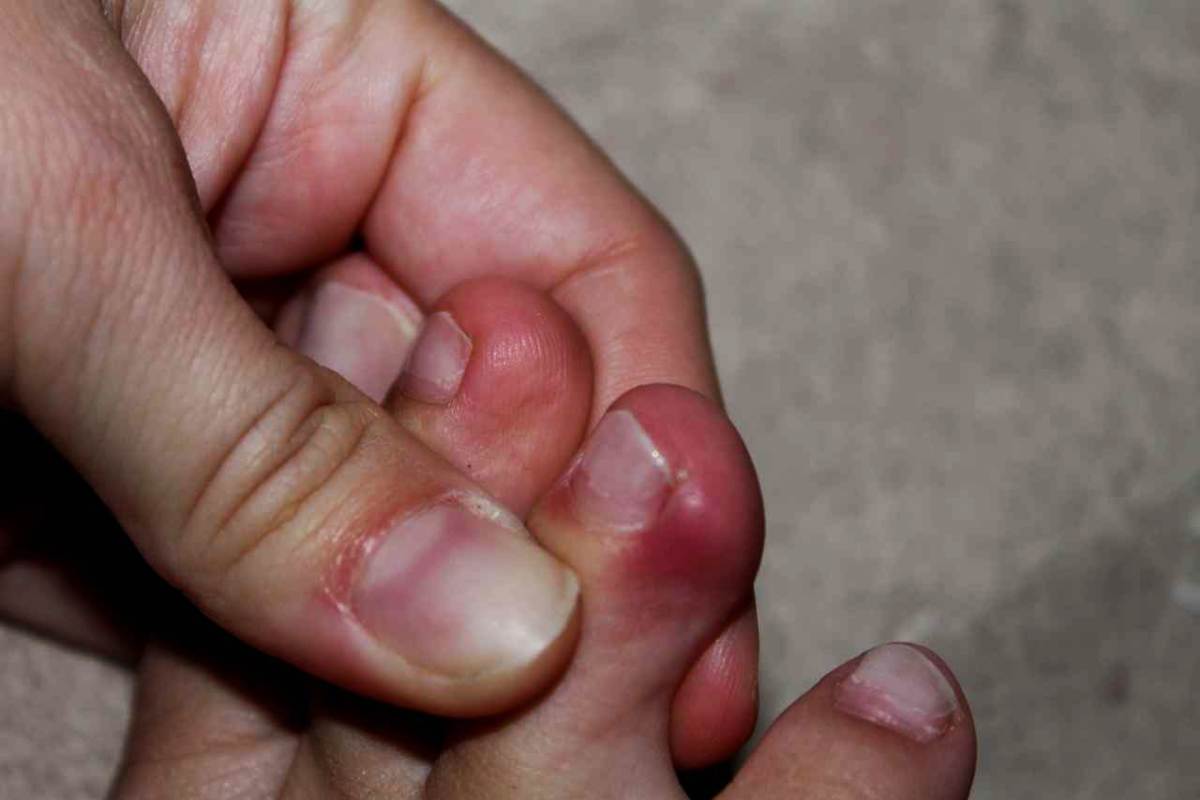 come riconoscere unghie incarnite