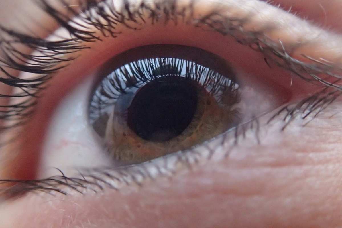 Glaucoma, è possibile accedere ai benefici della 104?